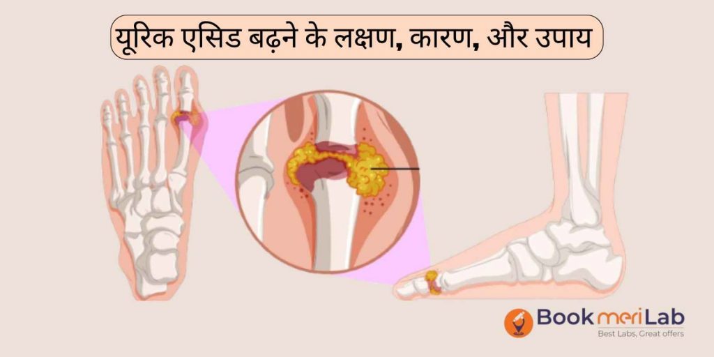 यूरिक एसिड बढ़ने के लक्षण, जानिये इसके कारण, और उपाय
