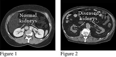 Normal Vs Abnormal CT Scan KUB