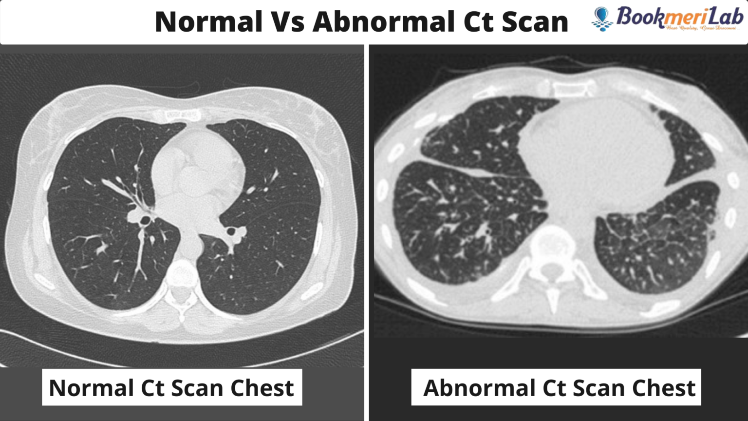 CT Scan Chest Purpose Results COVID 19 Cost 2022 CT Scan Chest Purpose Results COVID 19 Cost 2022