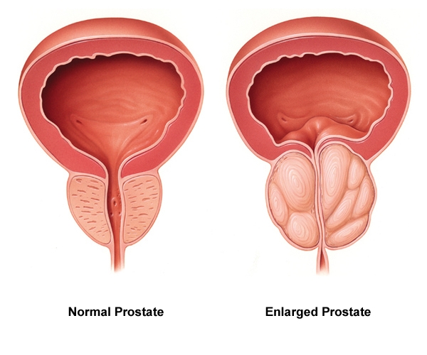 Normal Vs Enlarged Prostate

