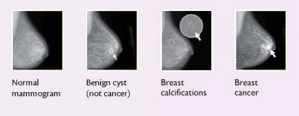 Common Breast Diseases (mammography)